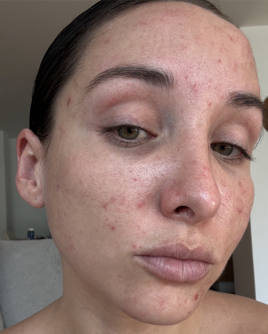 Before, acne