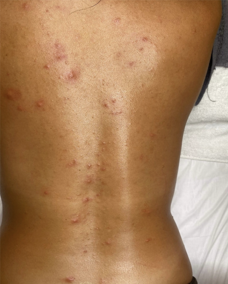 Before, back acne